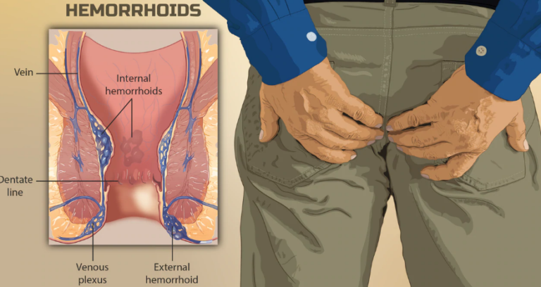 Homoeopathic remedies for hemorrhoids | Homoeopathic medicine for piles