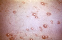 বসন্ত রোগের হোমিও চিকিৎসা ও তার প্রতিষেধক ওষুধ | Homeopathy medicine for chicken pox