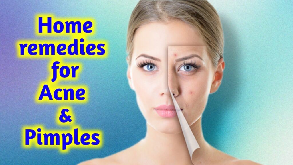 home remedies for acne